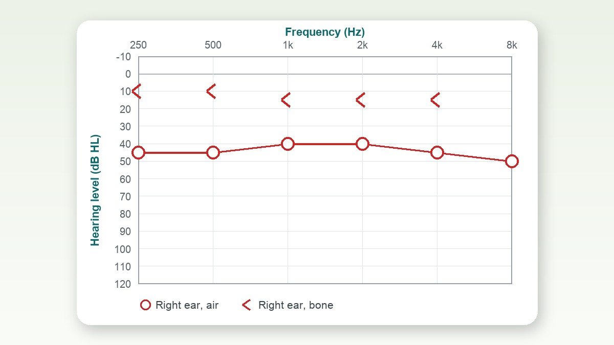 Air vs Bone Conduction on Your Audiogram (AC & BC Explained)