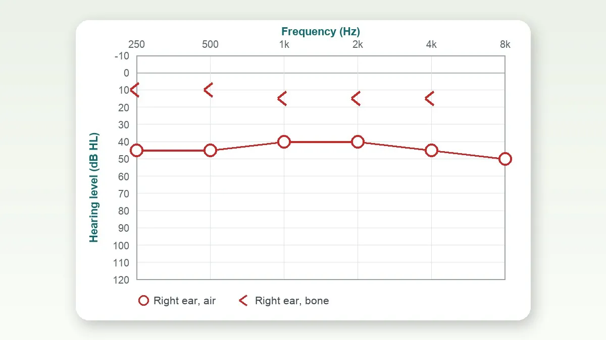 Air vs Bone Conduction on Your Audiogram (AC & BC Explained)