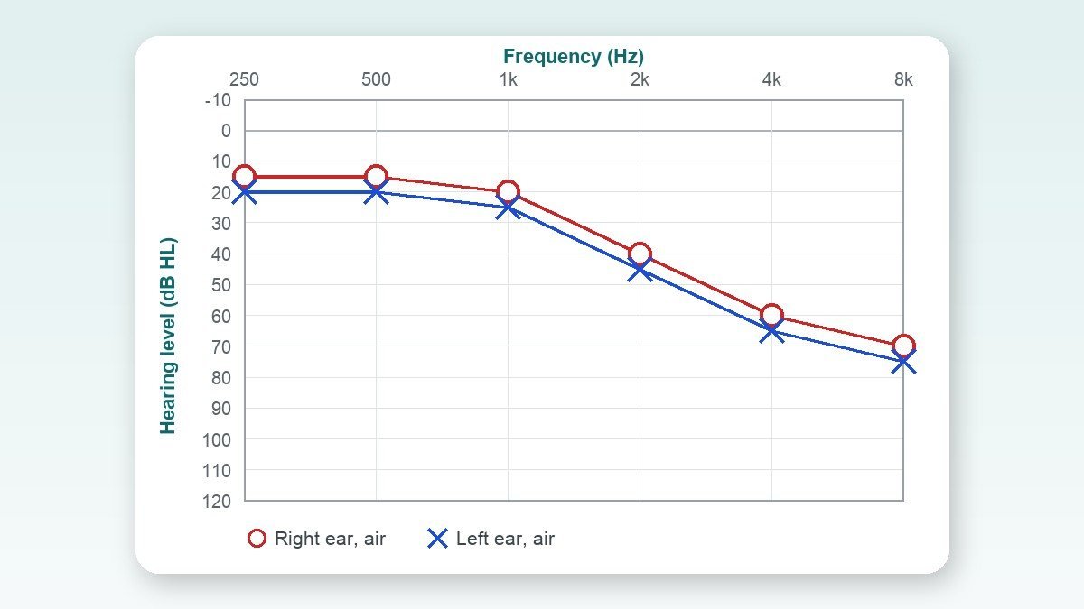 Hearing Aids for Sensorineural Hearing Loss (SNHL): Do They Work, and Which Type Suits You?