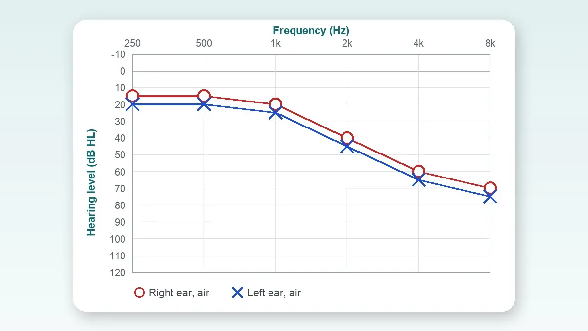 Hearing Aids for Sensorineural Hearing Loss (SNHL): Do They Work, and Which Type Suits You?