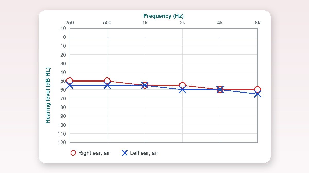 How Hearing Loss Percentage Is Calculated in India (with Formula)