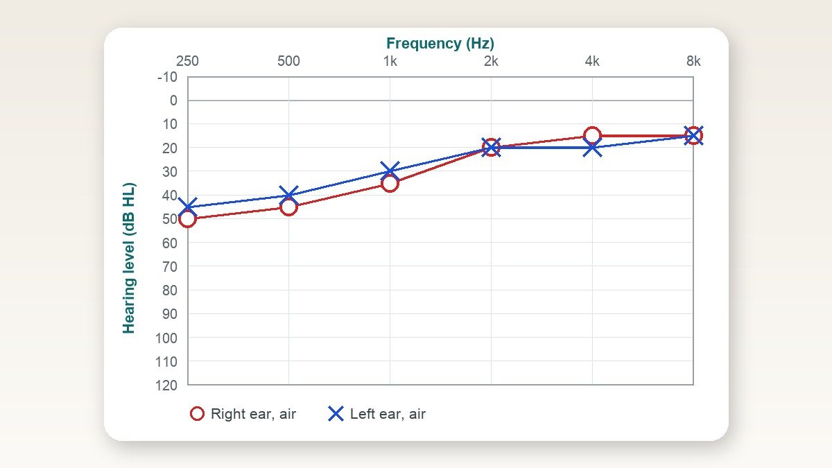 Low-Frequency Hearing Loss: Causes, What Your Audiogram Means, and When to Worry